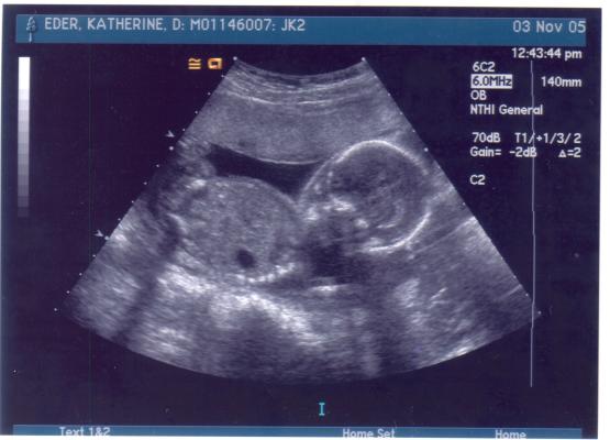 Ultrasound 20 weeks.
