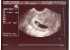 At 7 weeks the baby looks like a little lima bean, but you can see his heart beating. thumb