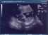 Our new baby via ultrasound. thumb