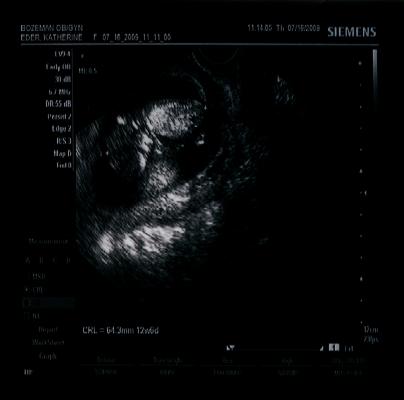 Ultrasound of the new baby