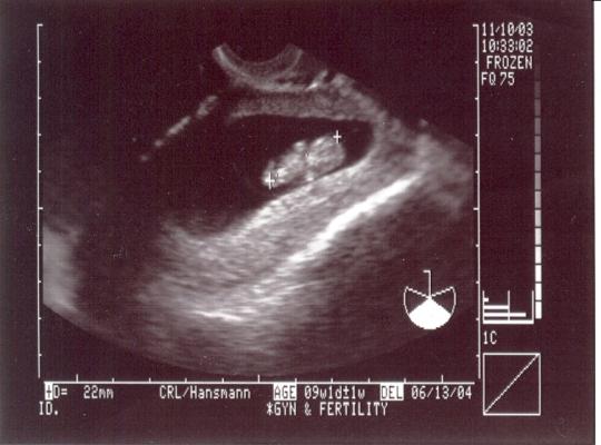 At 8 weeks and 5 days you can see baby's hands and feet starting to form. His head is quite large compared to his body.