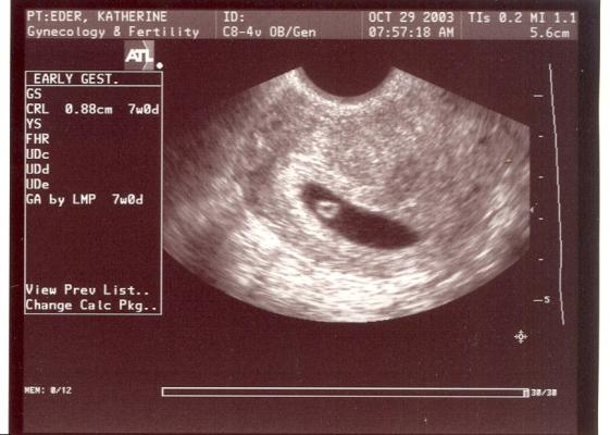 At 7 weeks the baby looks like a little lima bean, but you can see his heart beating.