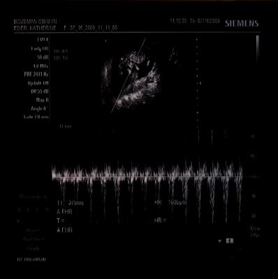 Heartbeat of the new baby