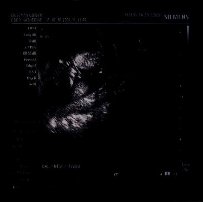 Ultrasound of the new baby